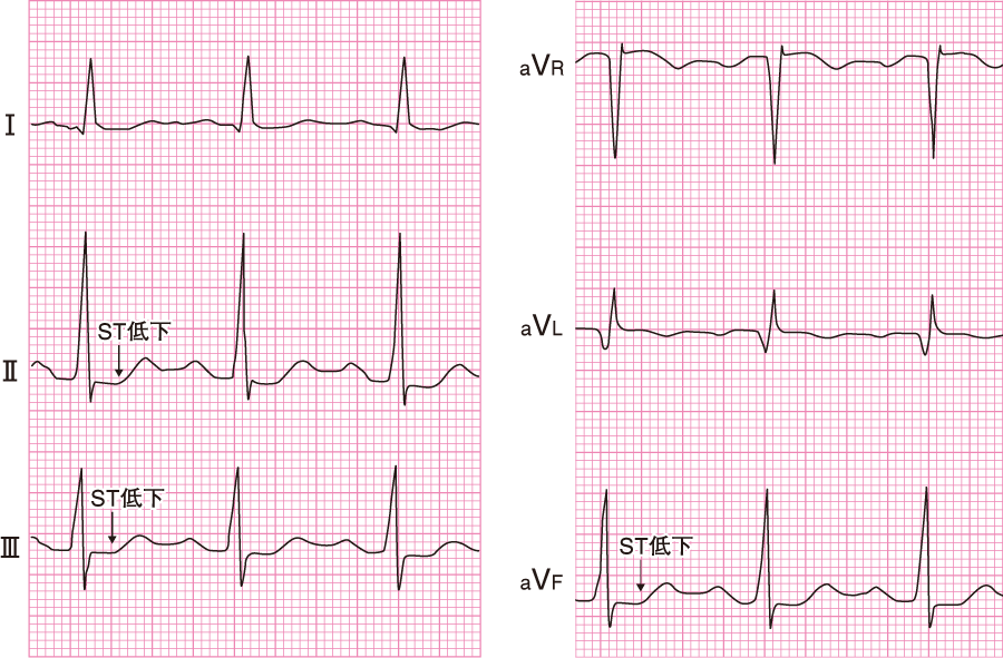 心筋虚血は常に心筋梗塞を引き起こすのでしょうか?