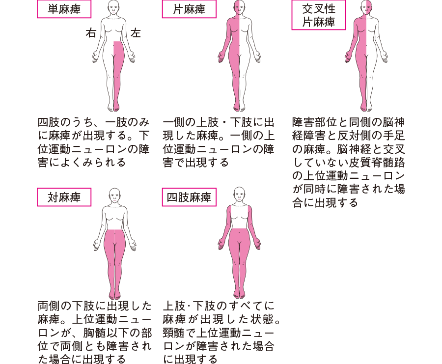 片麻痺の症状は何ですか?