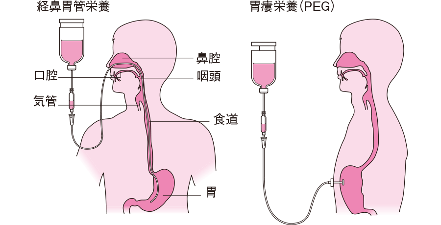 非経口栄養の準備はどのように行いますか?