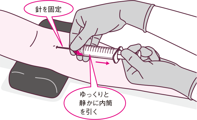 注射器による採血時の固定方法と内筒の引き方