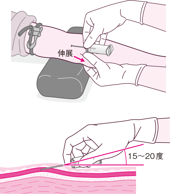 採血時の針の刺入角度と皮膚の固定方法