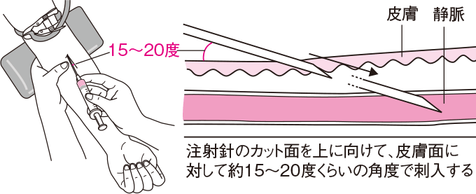 静脈内注射の刺入角度