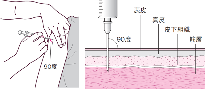 筋肉内注射の刺入角度