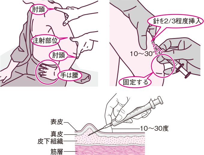 皮下注射を刺入する際の角度