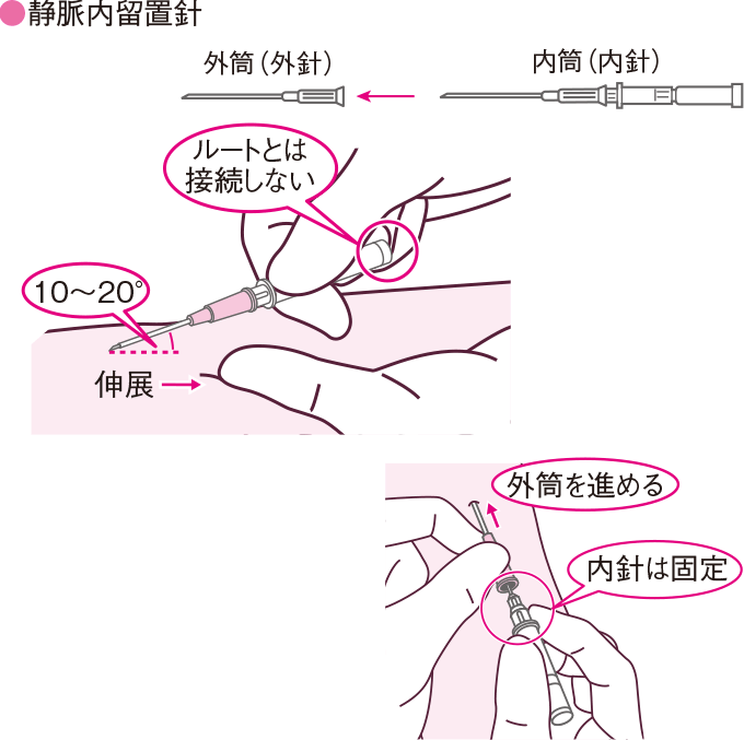 留置針と翼状針