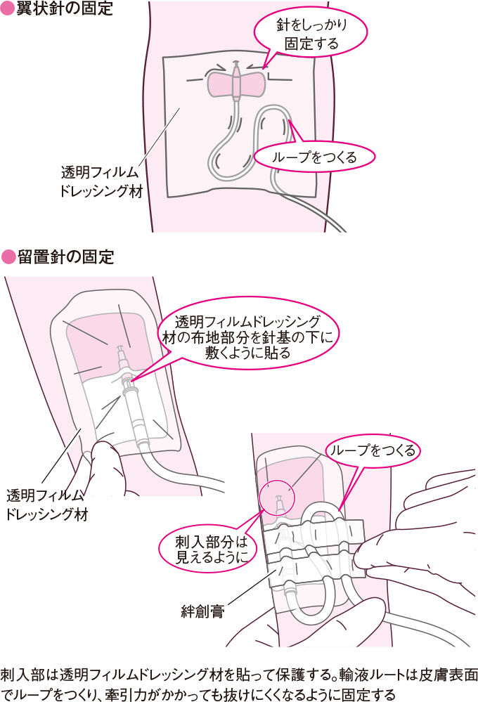 翼状針の固定