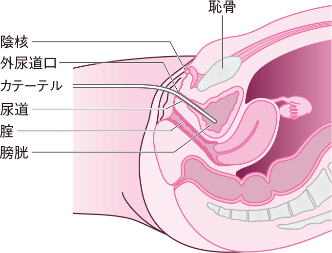 女性の導尿