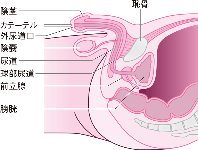 男性の導尿