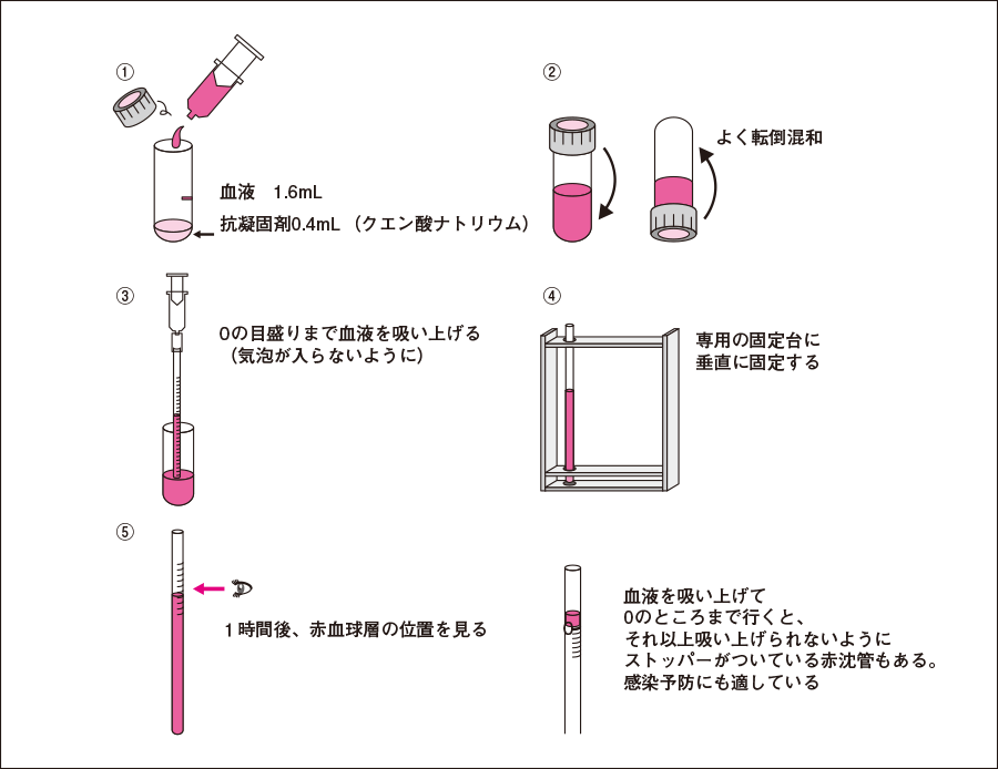 通常の ESR テスト結果はどのようなものですか?