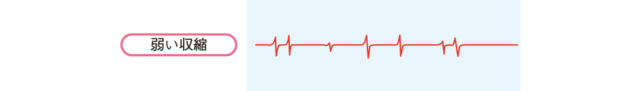 筋電図 Emg Electromyogram 看護roo カンゴルー