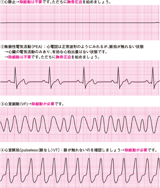 心停止の心電図