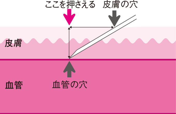 皮膚の穴と血管の穴のずれ