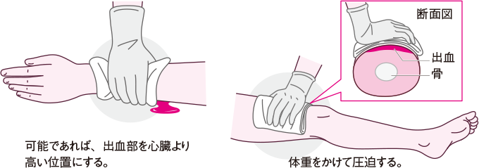 直接圧迫止血法