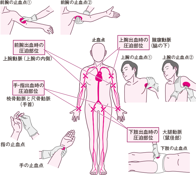 間接圧迫止血法