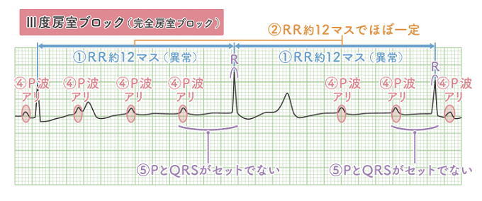 Ⅲ度房室ブロック
