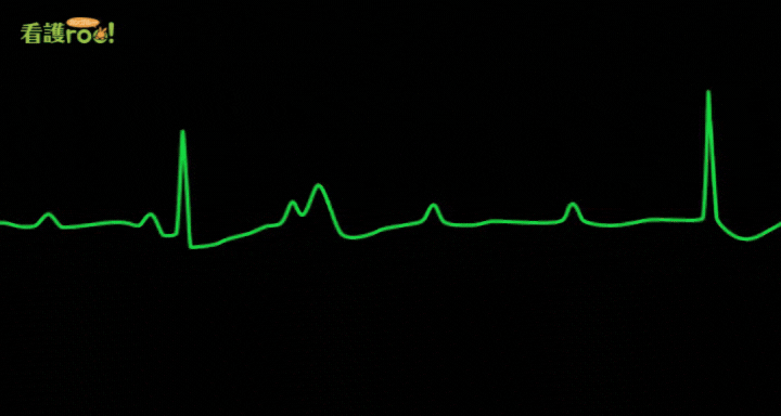 Ⅲ度房室ブロックの波形の例