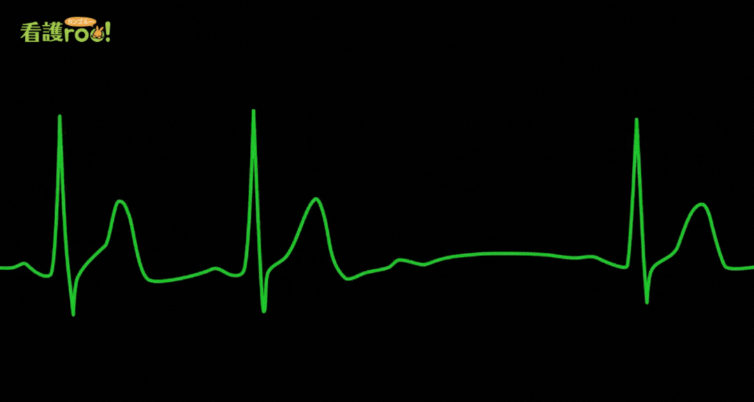 Ⅲ度房室ブロックの波形の例
