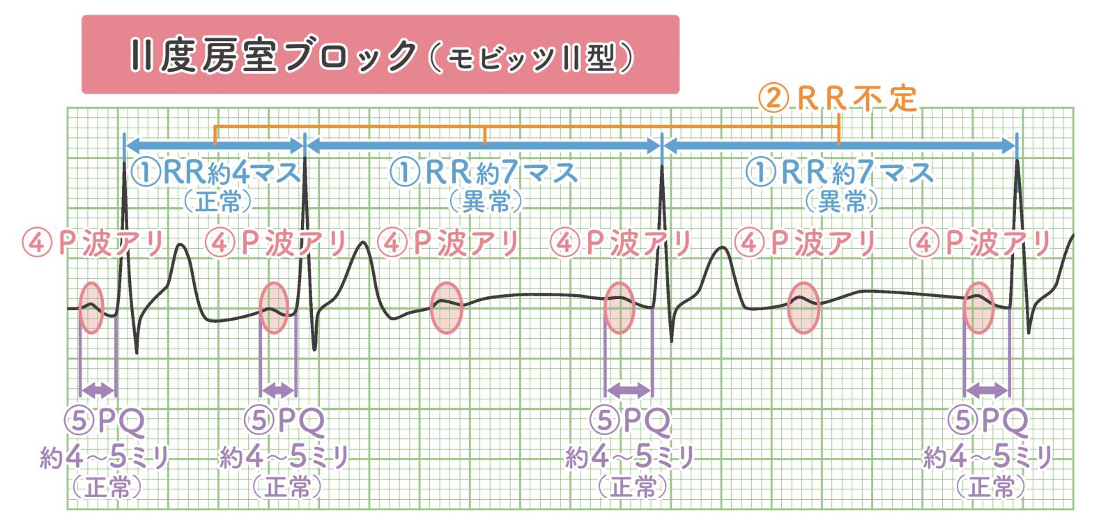 モビッツⅡ型Ⅱ度房室ブロック
