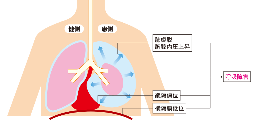 気胸(肺の虚脱) - 健康百科事典