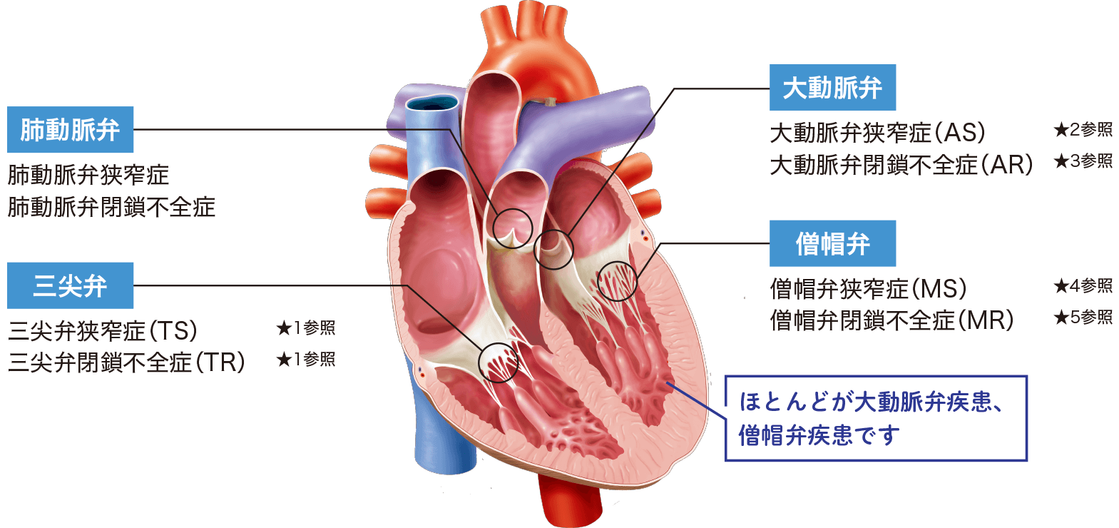 僧帽弁閉鎖不全症とは何ですか?
