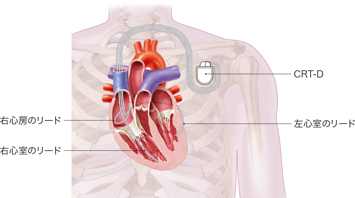 なぜ植込み型除細動器が必要なのでしょうか?