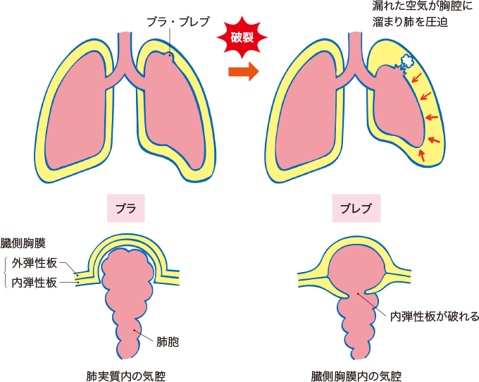 肺気腫を管理する方法