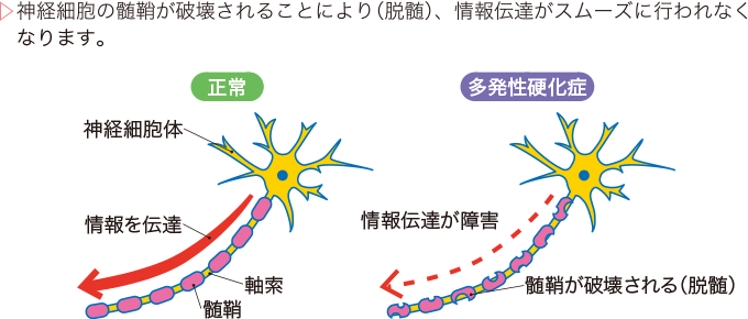 MSを診断する他の検査は何ですか?