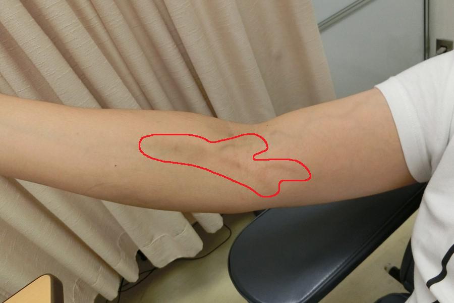 壊死性血管炎はどのように治療されますか?